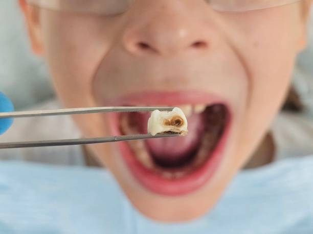 Best Emergency Dental Care for Broken or Chipped Teeth in Montara, CA